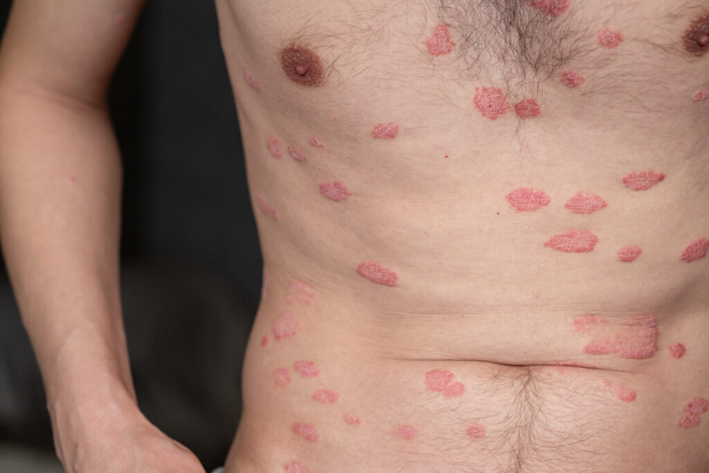 Herpes Zóster