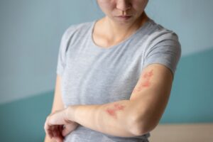 Herpes Zóster