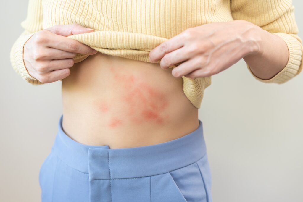 Herpes Zóster