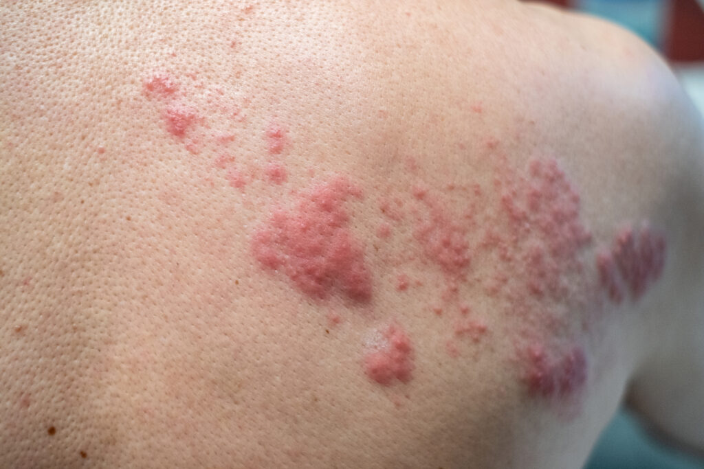Herpes Zóster
