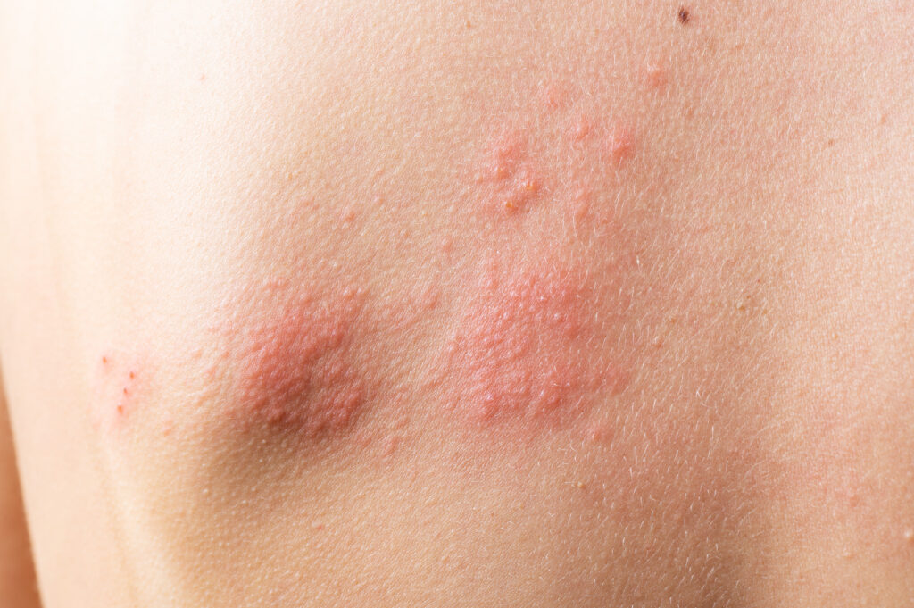Herpes Zóster